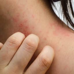 Close-up of contact dermatitis