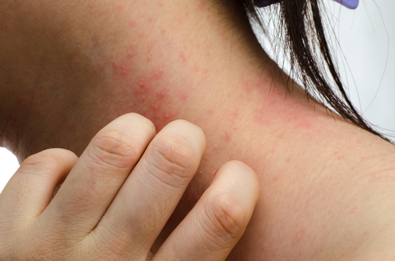 Close-up of contact dermatitis 