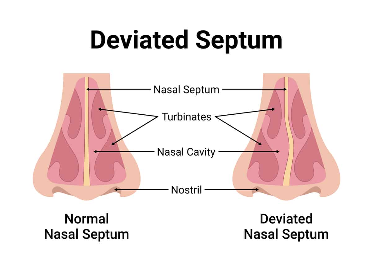 Deviated septum illustration.